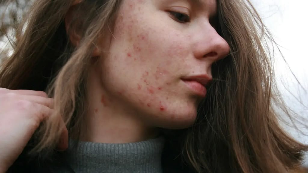 Acne treatment explained with clear skincare and blemish care