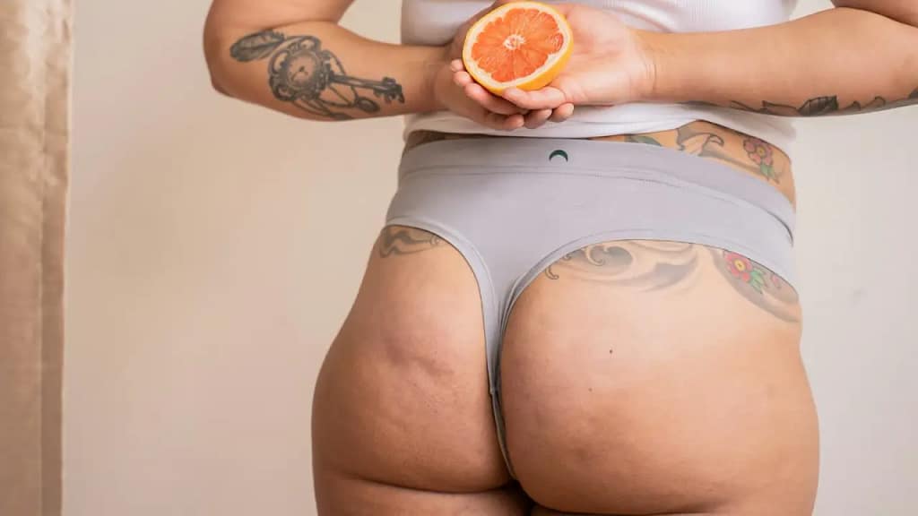 Cellulite explained with skin and connective tissue structure