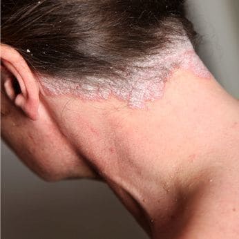 Natural Remedies for Psoriasis of the scalp.
