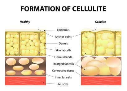 Inexpensive Cellulite Home Remedies