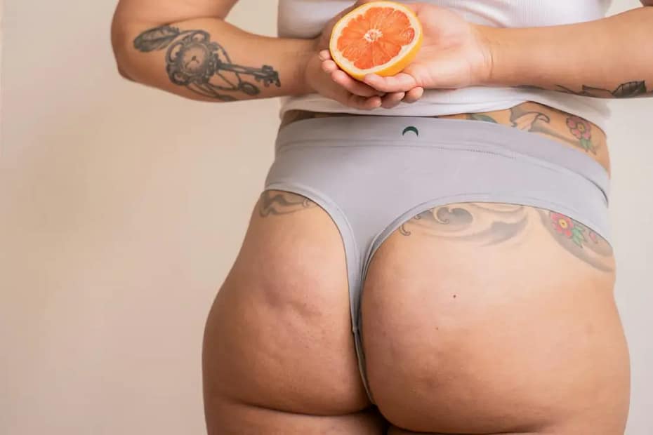 Cellulite explained with skin and connective tissue structure